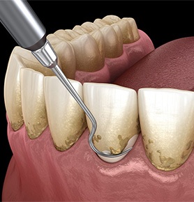 a computer illustration depicting scaling and root planing